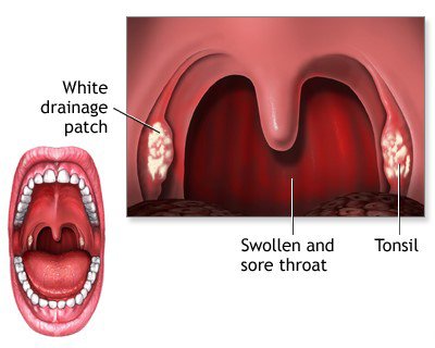 Tonsillitis